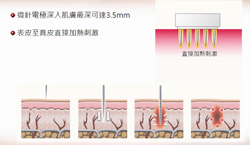 Ulthera极线音波拉提作用原理和适应人群有哪些？