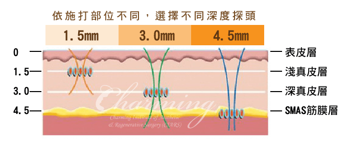 Ulthera极线音波拉提作用原理和适应人群有哪些？