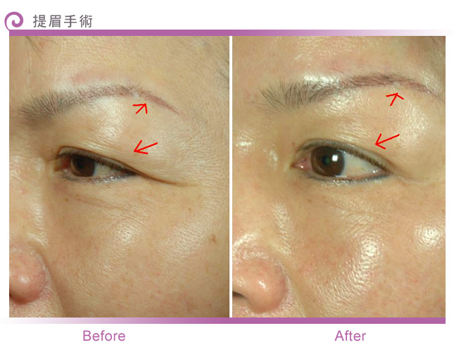 全脸整形拉皮手术安全吗？面部拉皮有什么风险？