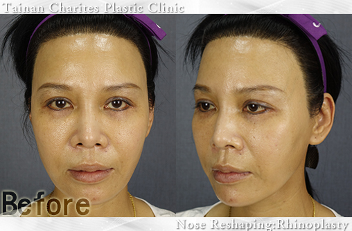 二段式隆鼻案例心得分享硅胶隆鼻取耳软骨